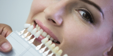 Composite Bonding in London: A Complete Guide