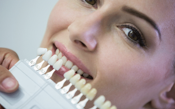 Composite Bonding in London: A Complete Guide